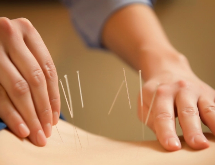 Иглорефлексотерапия - Оздоровительные услуги - Санаторий «Боровое»